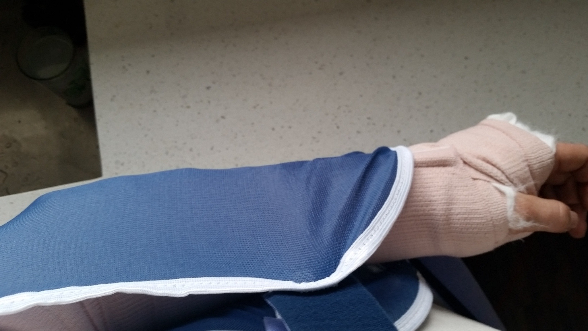 Broken Elbow Style Is Sleeveless